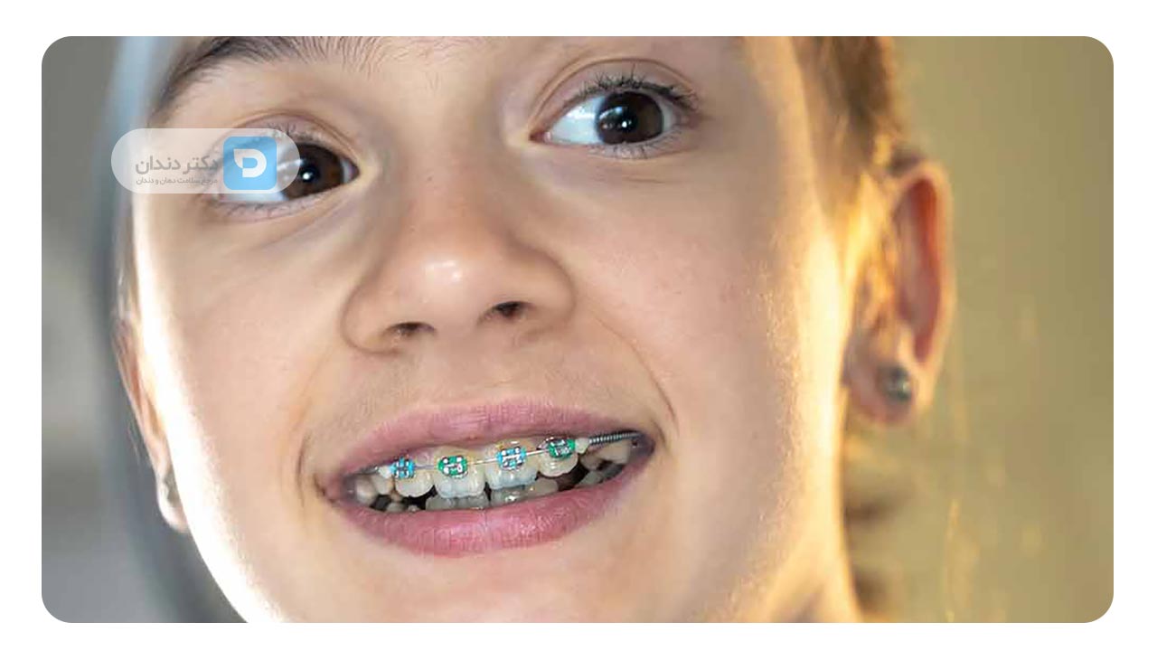 کشیدن دندان نیش برای ارتودنسی 