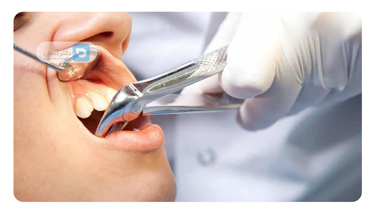 کشیدن دندان برای ارتودنسی