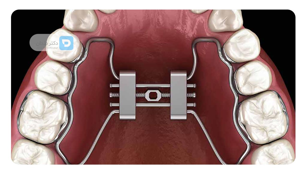 وسیع‌ کننده کام 