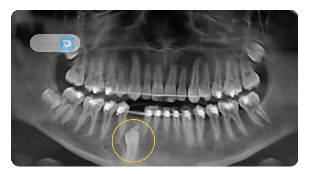 نهفته بودن دندان یکی از علل کشیدن دندان برای ارتودنسی