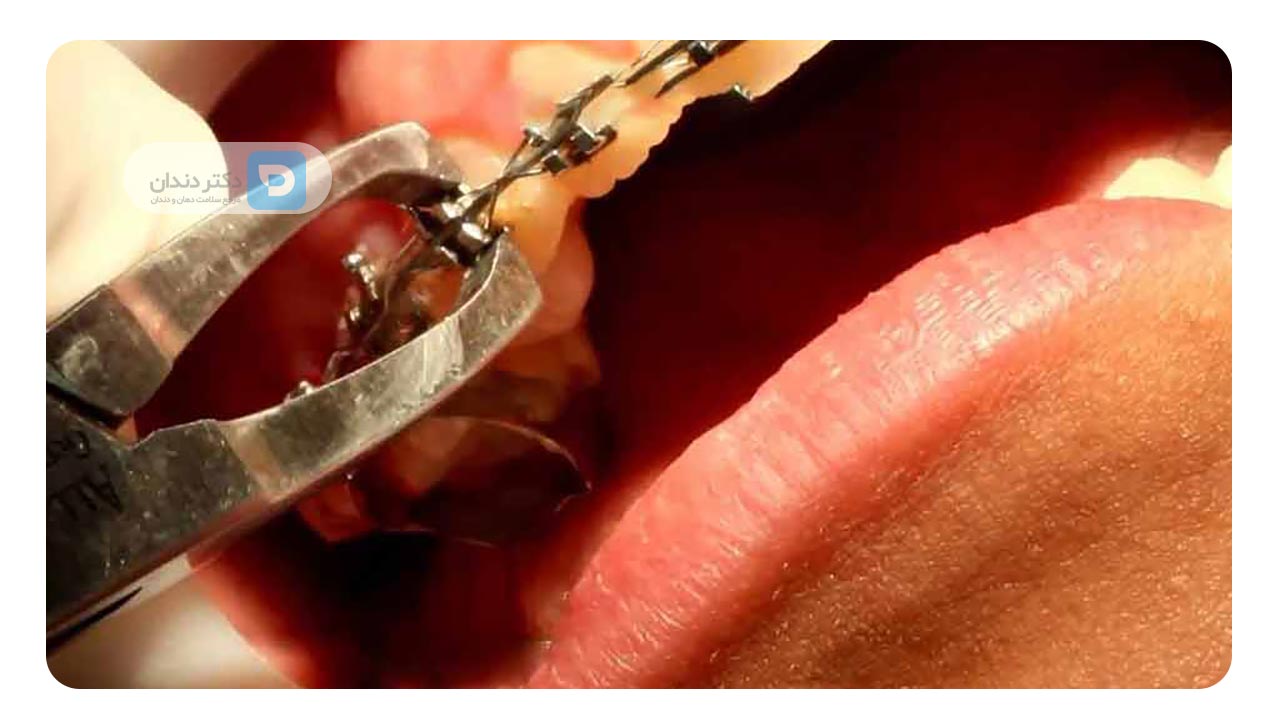  برداشتن بریس ارتودنسی 