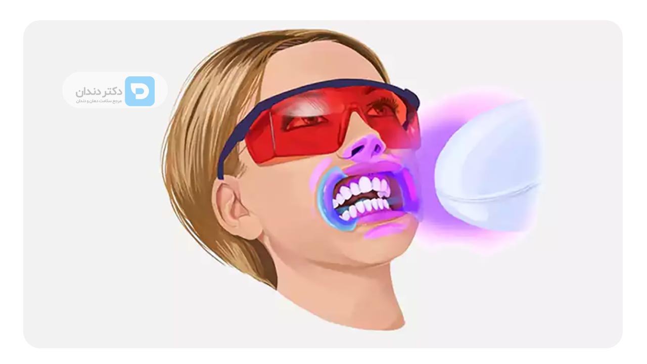 درمان سفید کردن دندان ها بعد از ارتودنسی در مطب