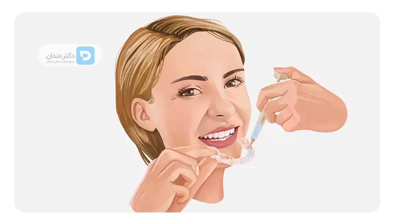 درمان سفید کردن دندان ها بعد از ارتودنسی در خانه