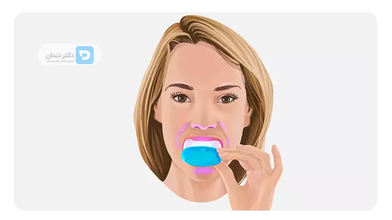 سفید کردن دندان ها در خانه بعد از ارتودنسی