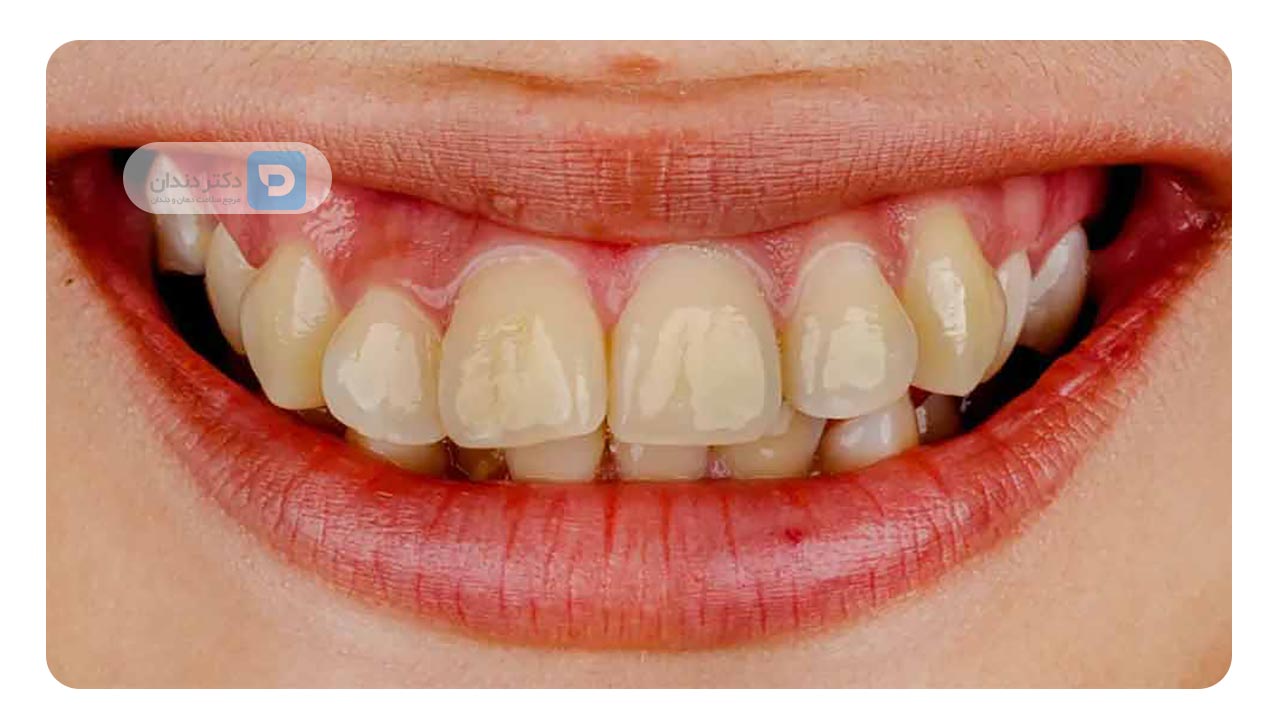 آیا ممکن است دندان‌ های ارتودنسی‌ شده سفید نشوند؟