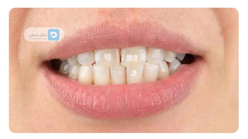 دمینرالیزاسیون و ایجاد لکه های سفید روی دندان
