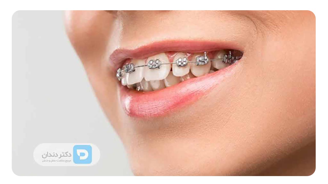 کاهش احتمال تحلیل دندان