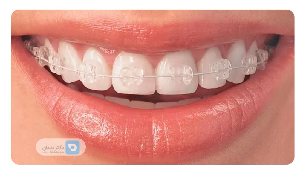 عدم تغییر رنگ براکت ها