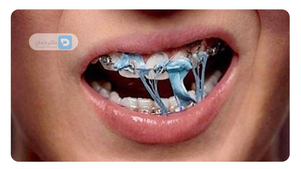 خوردن غذا های چسبناک