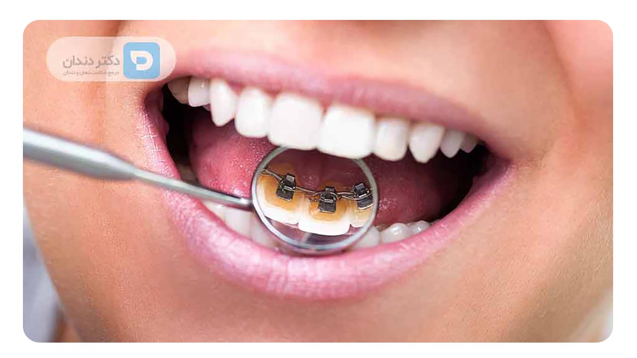 ارتودنسی نامرئی لینگوال