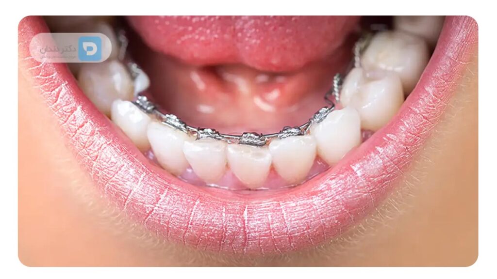 عکس ارتودنسی لینگوال واقعی