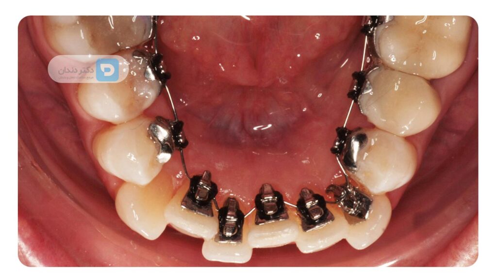 ارتودنسی لینگوال چه مشکلاتی را اصلاح می کند؟