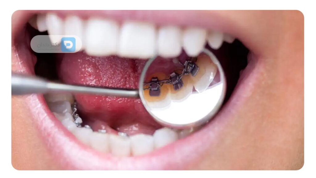 عکس ارتودنسی لینگوال