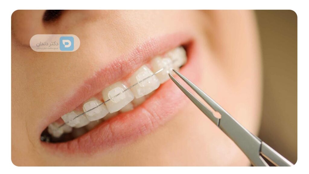 عکس ارتودنسی سرامیکی به عنوان یکی از بهترین روش ارتودنسی موجود