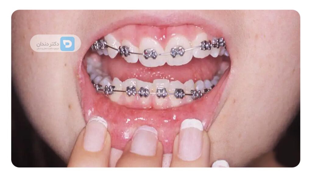 عکس ارتودنسی ثابت فلزی
