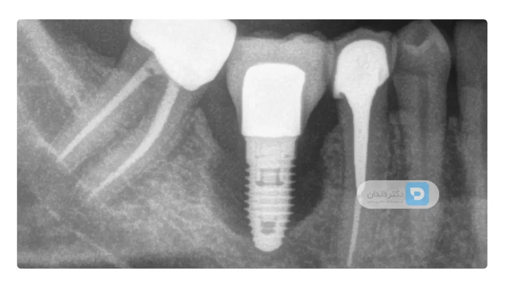 درد عفونت دندان