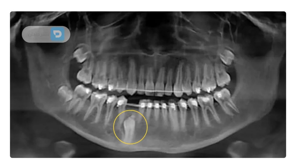 نهفته بودن دندان یکی از علل کشیدن دندان برای ارتودنسی