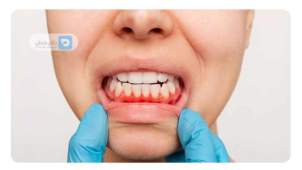 بیماری های لثه