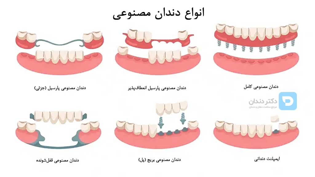 بهترین نوع دندان مصنوعی برای افراد جوان