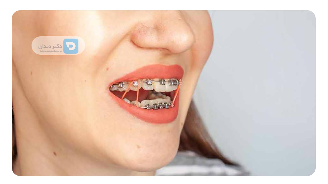 استفاده منظم از کشها یا سایر تجهیزات کمکی