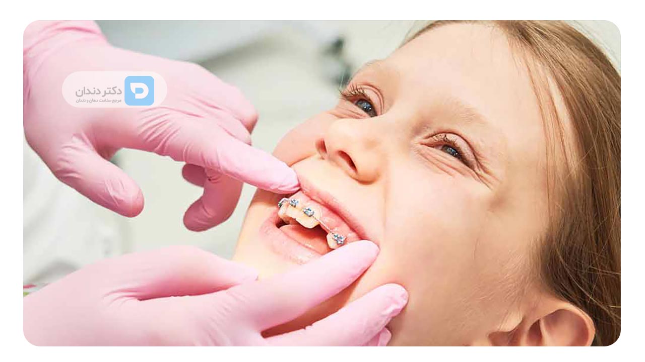 کشیدن دندان و تاثیر آن بر مدت زمان درمان ارتودنسی