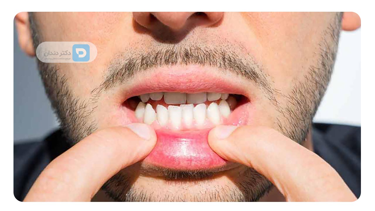 شدت ناهماهنگی دندان ها