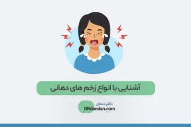 آشنایی با انواع زخم دهان