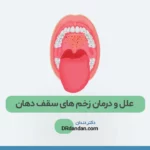 زخم سقف دهان عکس