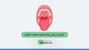 زخم سقف دهان عکس