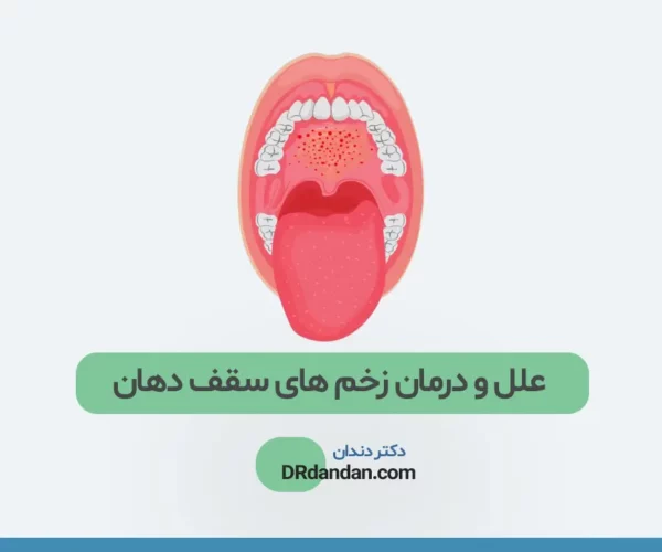 زخم سقف دهان عکس