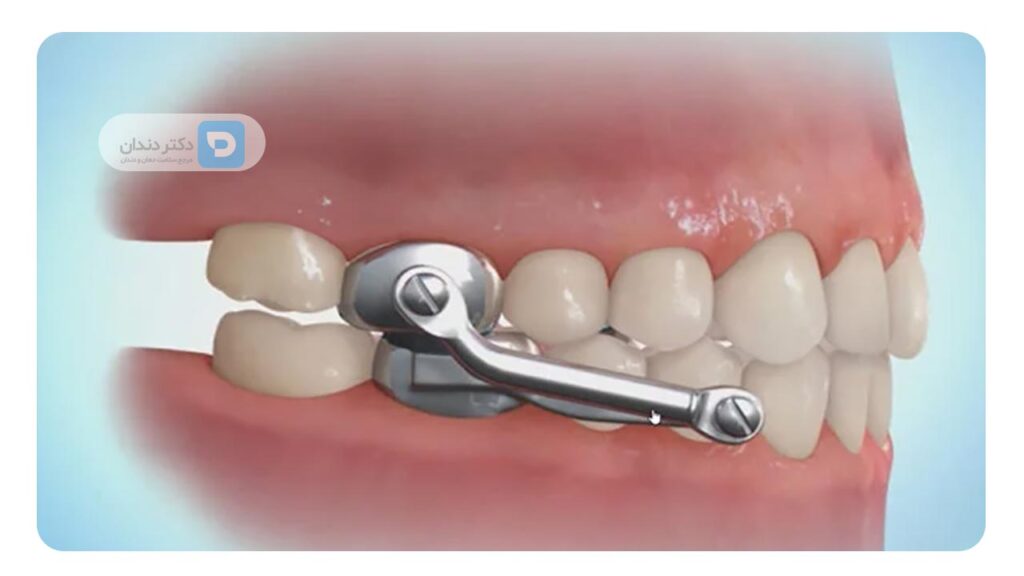 ارتودنسی فانکشنال