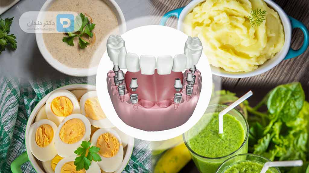 رژیم غذایی بعد از ایمپلنت