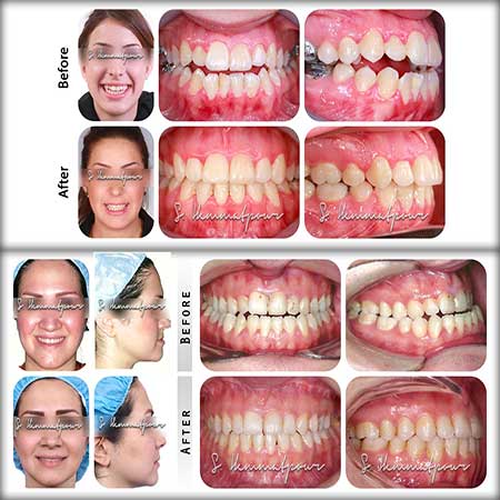 قبل و بعد ارتودنسی