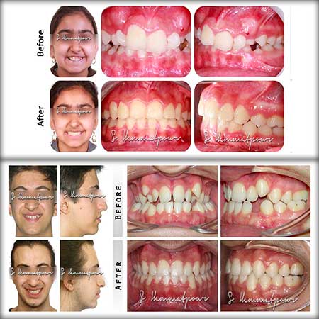 قبل و بعد ارتودنسی