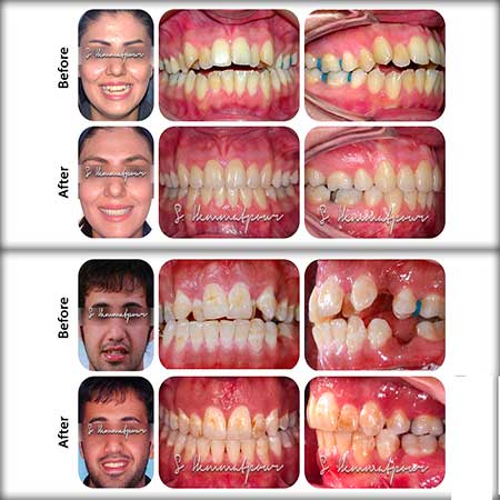 قبل و بعد ارتودنسی
