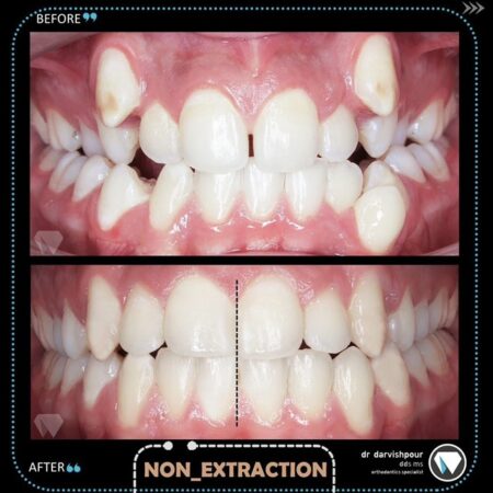 قبل و بعد ارتودنسی
