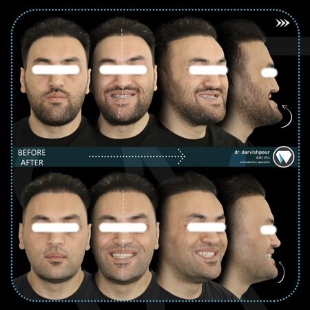 قبل و بعد ارتودنسی