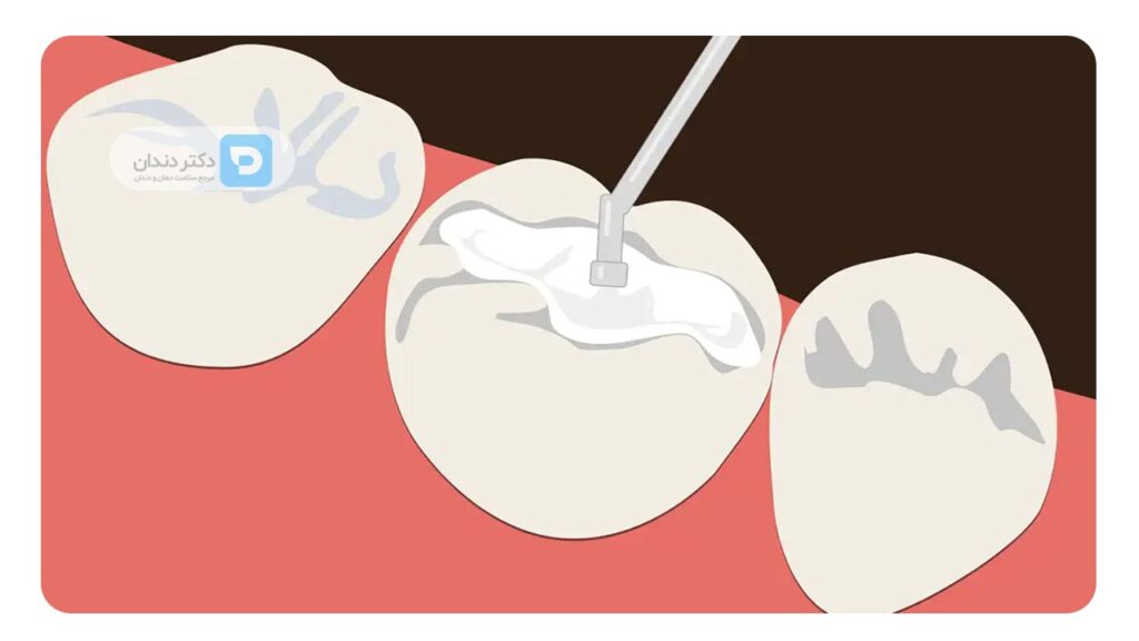 پرکردن دندان با مواد سفید