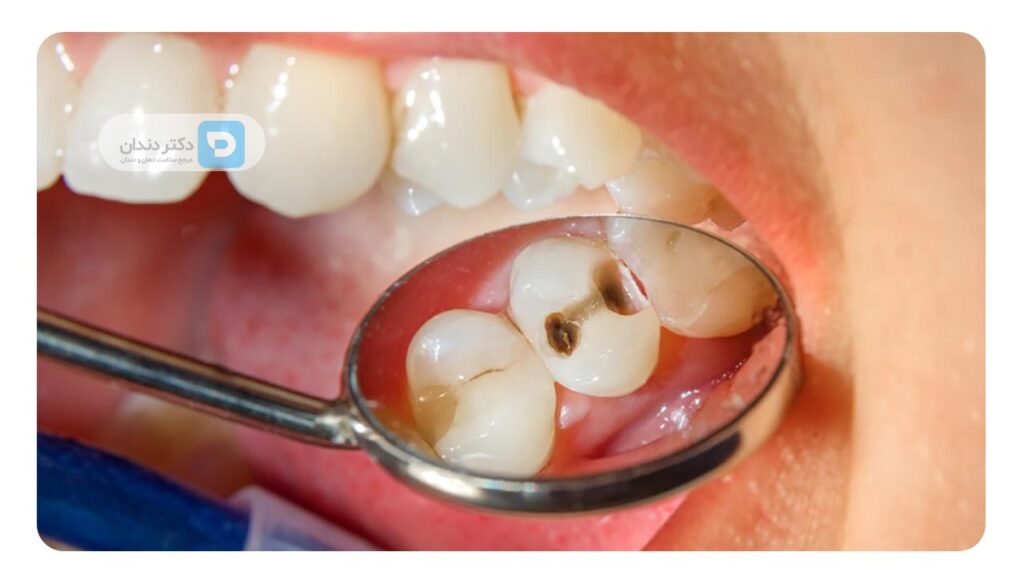 آیا می توان دوباره دندان را پر کرد؟