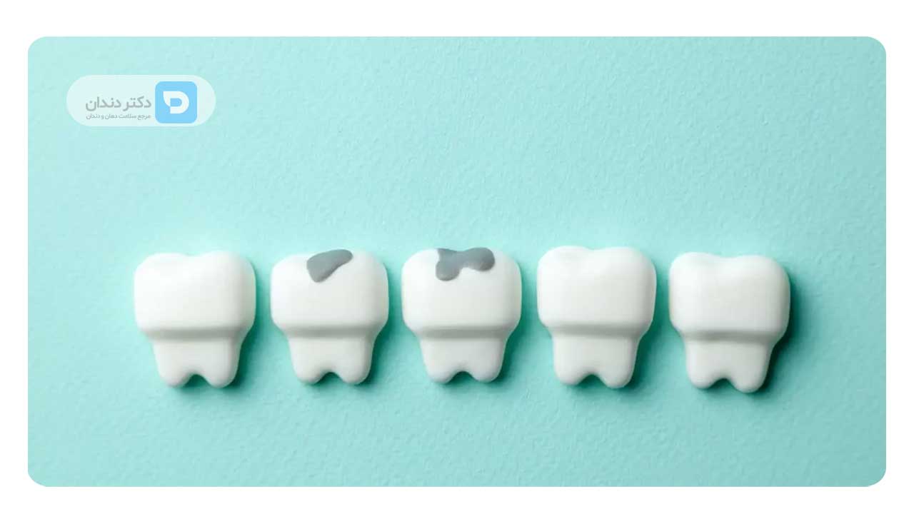 پرکردن دندان