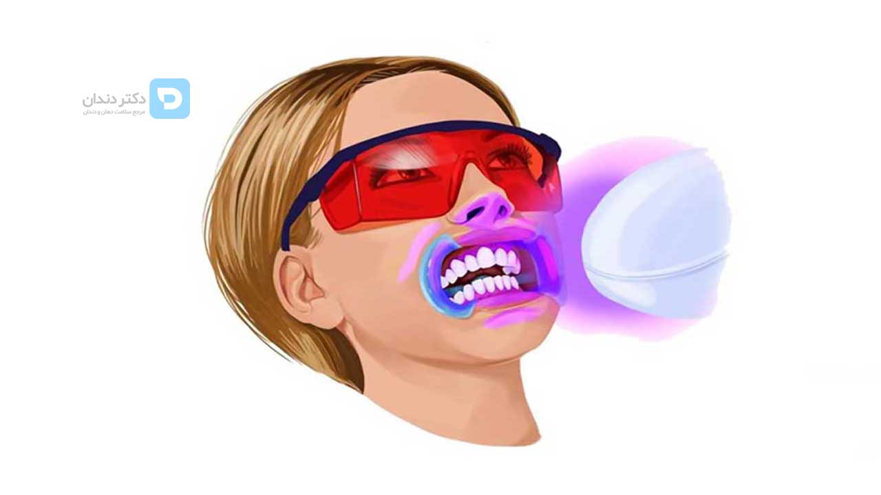 عکس شماتیک بلیچینگ دندان
