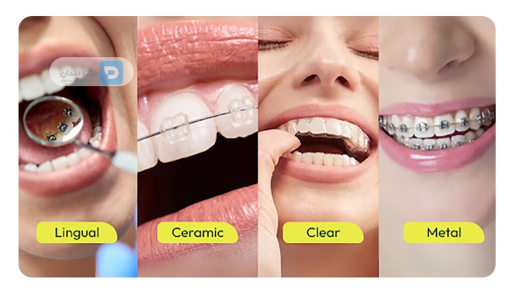 نوع براکت ارتودنسی در تغییر رنگ دندان ها