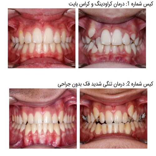 نمونه درمان ارتودنسی دکتر عارف