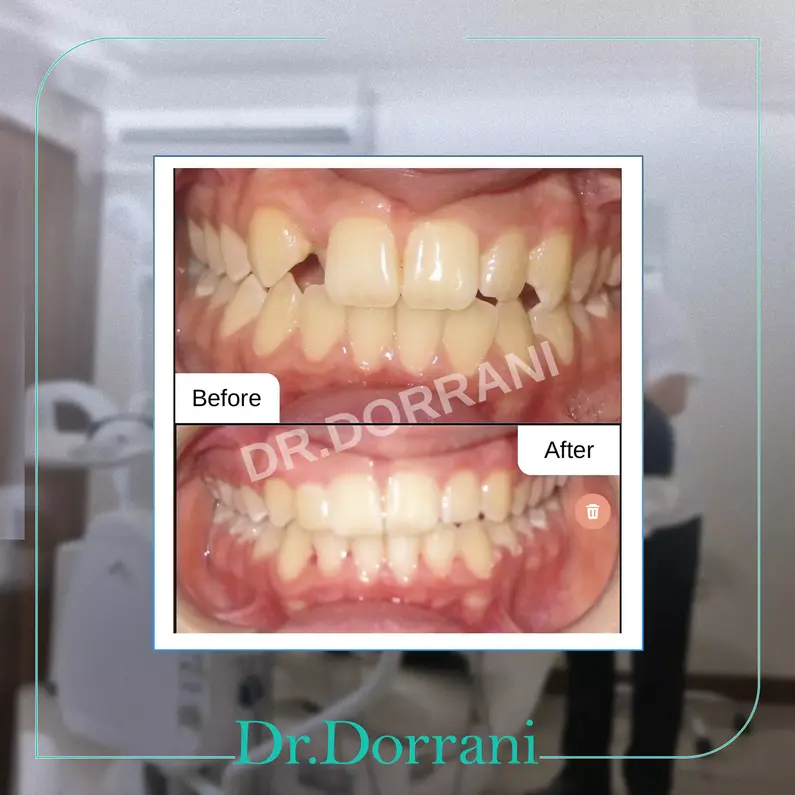 نمونه درمان ارتودنسی دکتر بهادر درانی