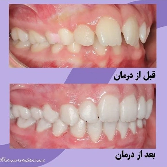 نمونه درمان ارتودنسی دکتر پروین خرازی