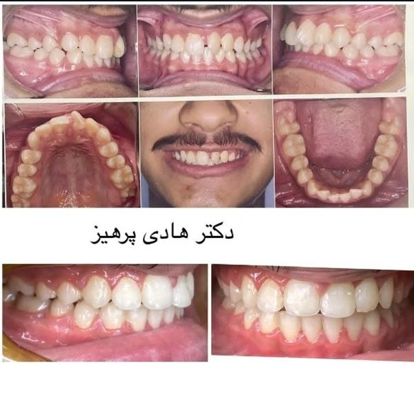 نمونه درمان ارتودنسی دکتر هادی پرهیز