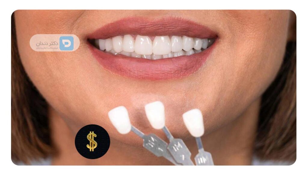 هزینه لمینت دندان 