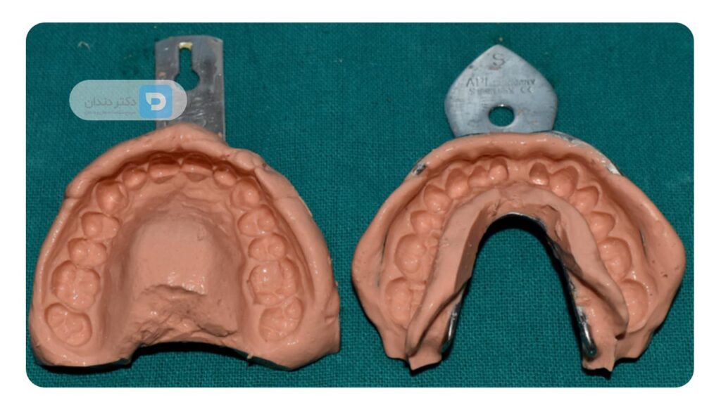 قالب گیری دندان ها